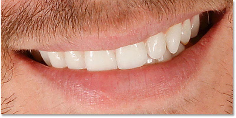 سفید کردن دندان در فتوشاپ